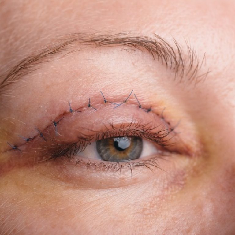 blefaroplastia-palpebra1